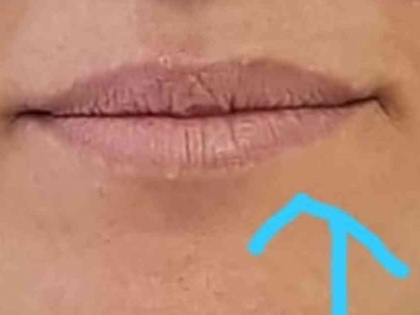 Harmonização Facial