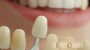 Lentes de Contato Dental: O Guia Definitivo para um Sorriso Perfeito.