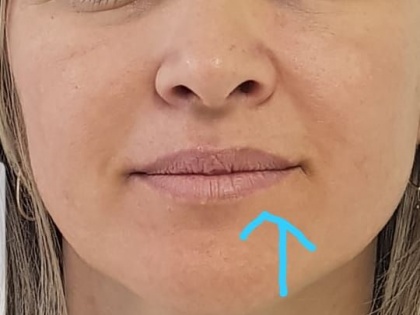 Harmonização Facial