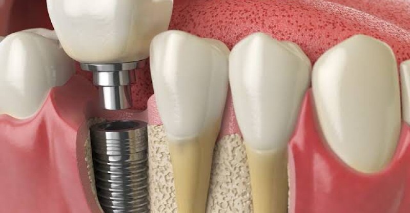 Implante dentário – Enxerto ósseo e técnicas cirúrgicas alternativas