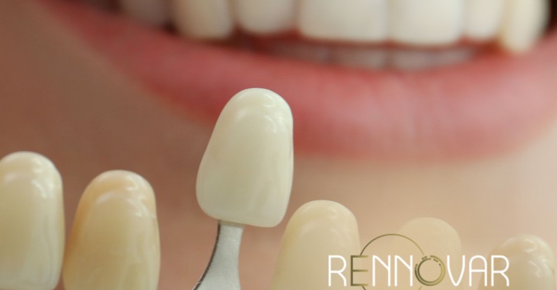 Lentes de Contato Dental: O Guia Definitivo para um Sorriso Perfeito.
