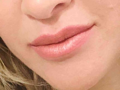 Harmonização Facial