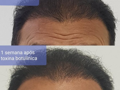 Harmonização Facial