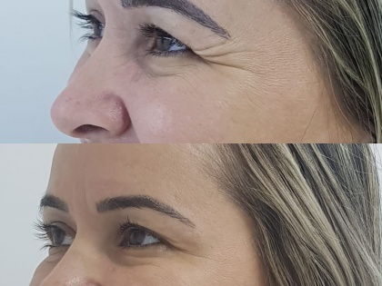 Harmonização Facial